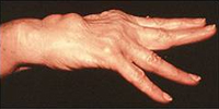 Rheumatoid Arthritis