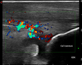 Ultrasound
