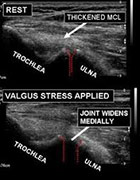 Diagnosis for Arthritis with the use of Ultrasound