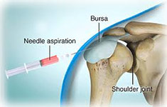 Joint injection & aspiration<