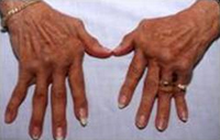 Rheumatoid Arthritis