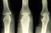 Rheumatoid Arthritis