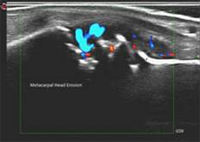 Rheumatoid Arthritis