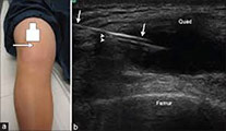 Diagnosis for Arthritis with the use of Ultrasound